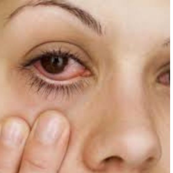 cay mắt do dị ứng bụi