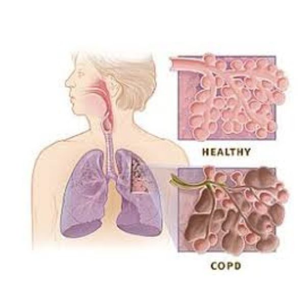 Bị khó thở khi nằm ngủ? Nguyên nhân và cách xử lý hiệu quả COPD